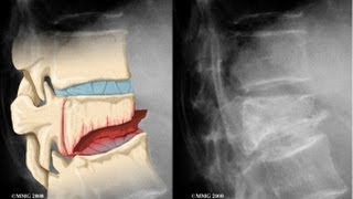 Vertebral Compression Fracture Explained by a Top Pain Physician in Las Vegas Nevada [upl. by Neelya]