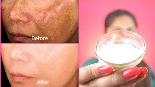 How To Get Rid of Hyper pigmentation  Freckles Dark Spots Melasma Black Patches Fast Naturally [upl. by Capone]