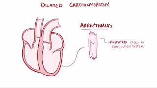 Dilated cardiomyopathy DCM causes symptoms diagnosis treatment amp pathology [upl. by Sieracki637]