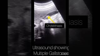 Ultrasound showing Gallstones Cholelithiasis ultrasound123ultrasonographyyoutubeshortsviralshort [upl. by Airottiv]