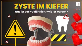 Zyste im Kiefer  Was ist das Entstehung Therapie und Folgen  Carree Dental Köln [upl. by Ahsinra836]