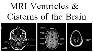 MRI ventricle and cisterns of the Brain [upl. by Violet]