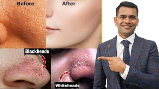 Blackheads Whiteheads Open Pores 100  Working Home Remedy  How To Shrink Pores [upl. by Akeenahs]