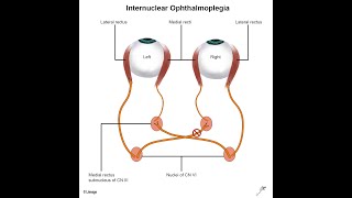 Cause of Opthalmoplegia  Lesion to 3rd 4th 6th cranial nerve [upl. by Enomrej407]