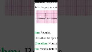 Sinus Bradyarrhythmia [upl. by Trinia633]