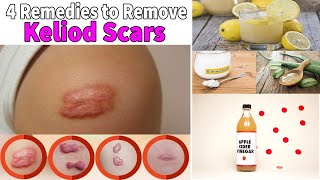 Keloid Scar Removal at Home 4 Remedies for Treatment of Scars [upl. by Nahgrom702]