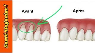 3 remèdes naturels pour réparer les gencives qui se rétractent [upl. by Keeton]