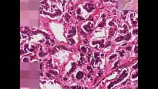 Histopathology LungBronchial carcinoid [upl. by Lubow693]