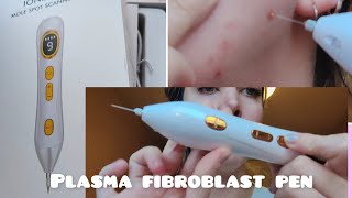 plasma fibroblast pen  alternative to Dermavel  review [upl. by Attolrac140]