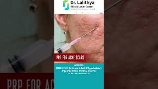 PRP Treatment Acne Scars  Motimalu  Dr Lalithya Kadimi  Dr Lalithya Derma Nalgonda [upl. by Eanil]