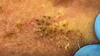 Big Cystic Acne Blackheads Extraction Blackheads amp Milia Whiteheads Removal Pimple Popping 015 [upl. by Notyal655]