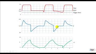 Ventilator Asynchrony Auto triggering due to Air Leak [upl. by Modeerf]