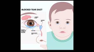 ជំងឺស្ទះរន្ធទឹកភ្នែក NasoLacrimal Duct ObstructionDacryostenosis [upl. by Nola]