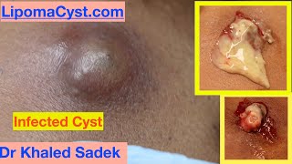 Infected Cyst Dr Khaled Sadek LipomaCystcom [upl. by Edette]