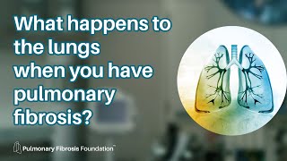 What is the BEST treatment for pulmonary fibrosis [upl. by Airakaz]