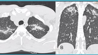 pneumoconiosis [upl. by Ecnal]