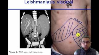 Esplenomegalia Un enfoque fisiopatologico umh 1931 [upl. by Egan]