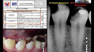 Urgências Endodônticas da Polpa Viva Prof Érico Lemos [upl. by Konstance109]