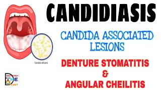 CANDIDIASIS  CANDIDA ASSOCIATED LESIONS  DENTURE STOMATITIS amp ANGULAR CHEILITIS [upl. by Bailey28]