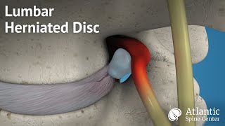 Lumbar Herniated Disc Overview [upl. by Demakis]