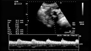 8 weeks fetal heart rate  ultrasound [upl. by Petronella]