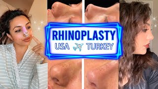 BULBOUS THICK SKIN RHINOPLASTY VLOG TURKEY  DR RESIT BURAK KAYAN  NOSE JOB TURKEY  Hadia [upl. by Eiznik]