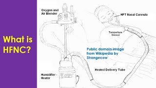 What is HFNC [upl. by Pennie232]