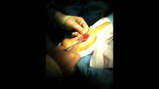 Achilles Tendon Rupture Repair Surgery  Houston Foot Surgeon [upl. by Nameerf568]