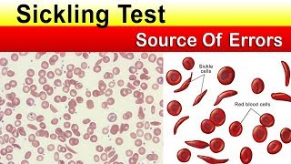 Sickling test Source of errors  Must Watch Before The Test [upl. by Feer317]