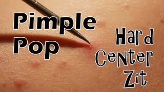 Pimple Pop  Hard Center Zit High Definition 1080p [upl. by Jammie]