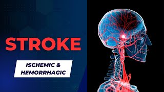 Ischemic and Hemorrhagic Strokes Signs Symptoms and Treatment [upl. by Retsek]