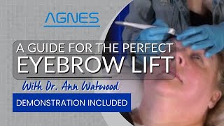 Agnes Nonsurgical Brow Lift StepbyStep Demonstration to Correct Brow and Lid Ptosis [upl. by Ettennahs]