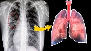 How to Cure Pneumonia Without Antibiotics  8 Home Remedies to Treat Pneumonia at Home [upl. by Arny]