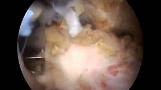 Arthroscopic Subscapularis repair and biceps tenodesis [upl. by Kirkwood]