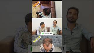 Hair Transplant Results Raipur Chhattisgarh  Hair Transplant 5 Months Result fue hair shorts cg [upl. by Tse]