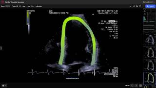 Strain Assessment on the Siemens SC2000  Step by Step Guide [upl. by Eneleh]