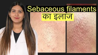 Sebaceous filaments pores on nose treatment in Hindi  नाक पर दिखने वाले पोर का इलाज [upl. by Nieberg]