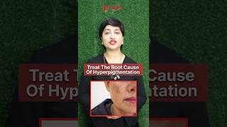 Unveiling the Truth About Hyperpigmentation Mrs Medha Singhs Expert Insights juvenaherbals [upl. by Adihsaar]