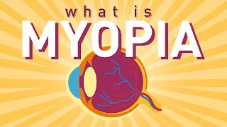 What is Myopia Short sightedness [upl. by Ricarda]