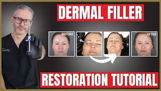 Dermal Filler Demonstration amp Tutorial  Liquid Rhinoplasty  Nasolabial Folds [upl. by Noroj]