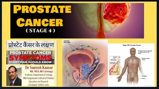 Prostate Cancer Stage 4 Prostate Cancer Metastatic Prostate Cancer DrProfSantosh Kumar PGI [upl. by Basset]