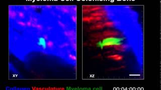 Myeloma Cell Colonising Bone [upl. by Mani321]