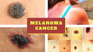 Melanoma Symptoms  Causes Pictures Stages Signs and Symptoms of Melanoma Skin Cancer Tumor [upl. by Anigriv]