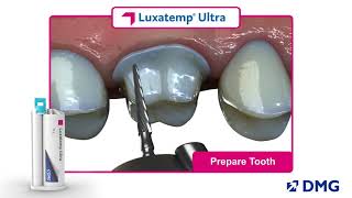 Luxatemp Ultra Rated 1 in Flexural Strength [upl. by Norud]