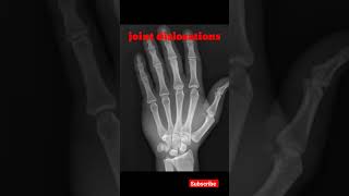 Joint Dislocation  hand xray shorts shortsfeed radiology jointdislocation education [upl. by Kcirdla]