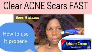 Get rid of Acne scars pimples  how to use epiderm cream properly answering questions [upl. by Oisinoid]