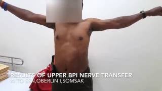 Results of Upper BPI nerve transfers [upl. by Allina723]