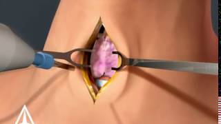 Tracheotomy  3D animation [upl. by Retsek]