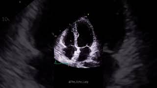 Closure device in situ 🩵🫀 cardiology amplatzer cardiologia echocardiogram [upl. by Duong]