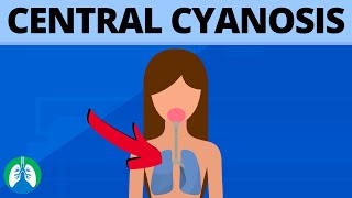 Central Cyanosis Medical Definition  Quick Explainer Video [upl. by Ecirtra509]